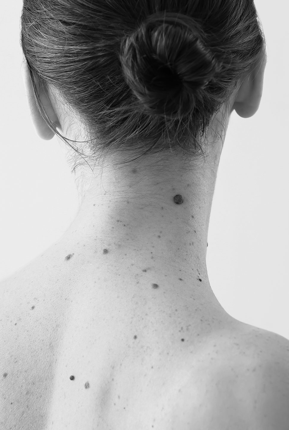 Woman neck moles